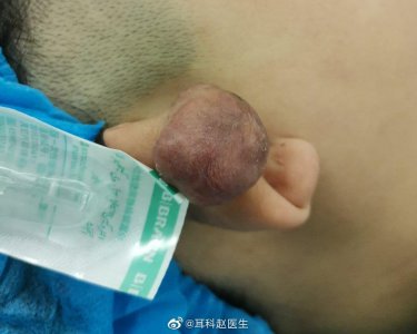 ​这是在耳廓上打耳钉后形成的瘢痕疙瘩，奉劝各位妹子打耳钉要谨慎